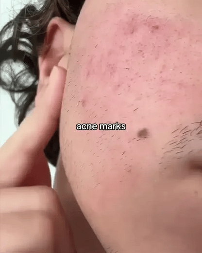 DV21 Acne Serum